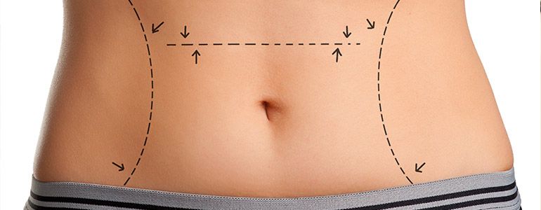 How Long To Wear an Abdominal Binder After Surgery, Leonisa
