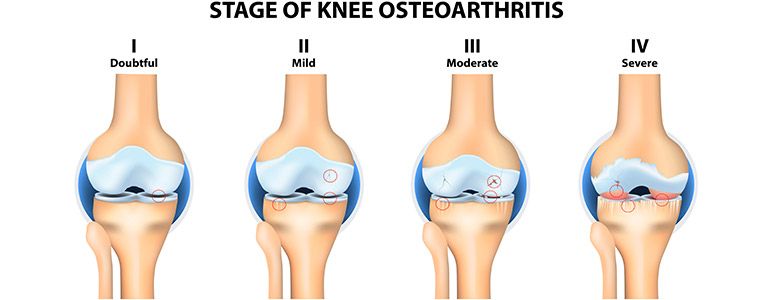 Knee Osteoarthritis