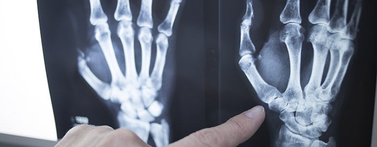 Thumb Joint Arthritis