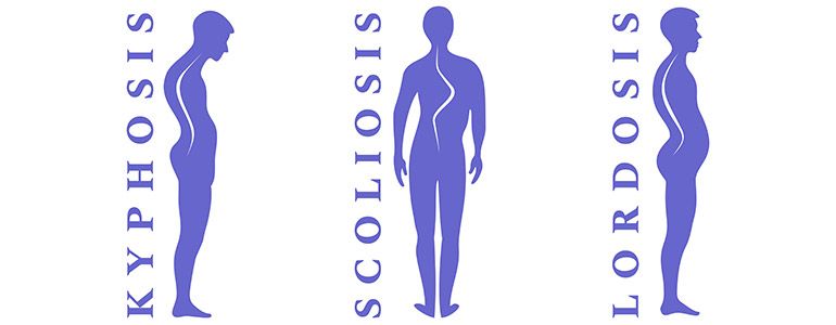 Kyphosis Posture Problem