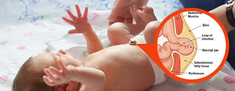 Umbilical hernia in babies-what is it? Does it need any treatment