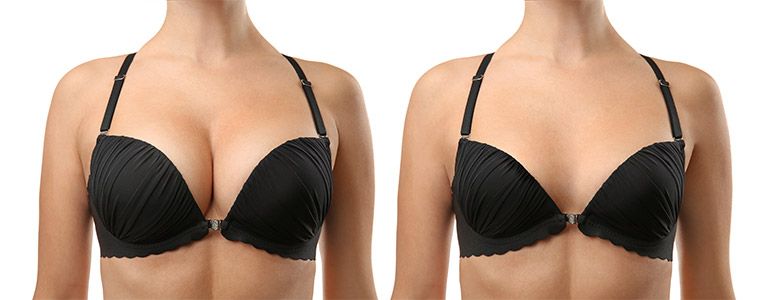Breast Implant Surgery - What to Expect After Breast Augmentation? –  Everyday Medical