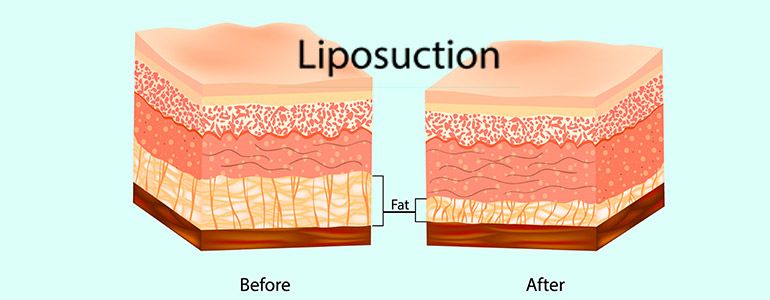 liposuction procedure