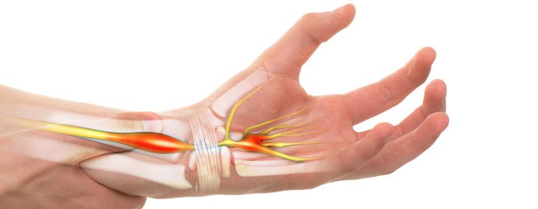 Carpal Tunnel Syndrome