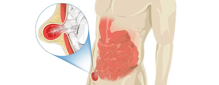 Abdominal Hernia Support