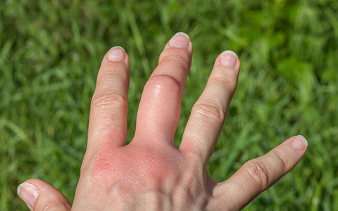 Wasp sting allergy can cause greater than usual swelling as on this person’s hand. Reactions can even affect your whole arm