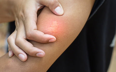 Person holding their arm which is red and swollen after being stung by a bee. This could be a milder symptom of bee allergy