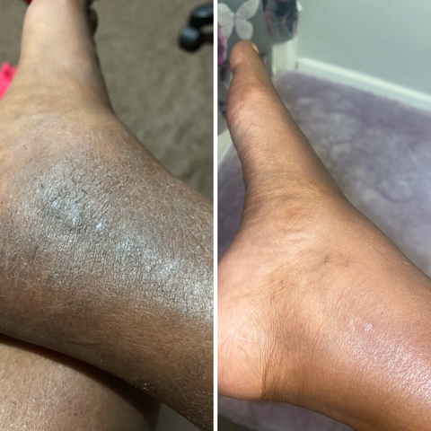 ECZEMA FEET