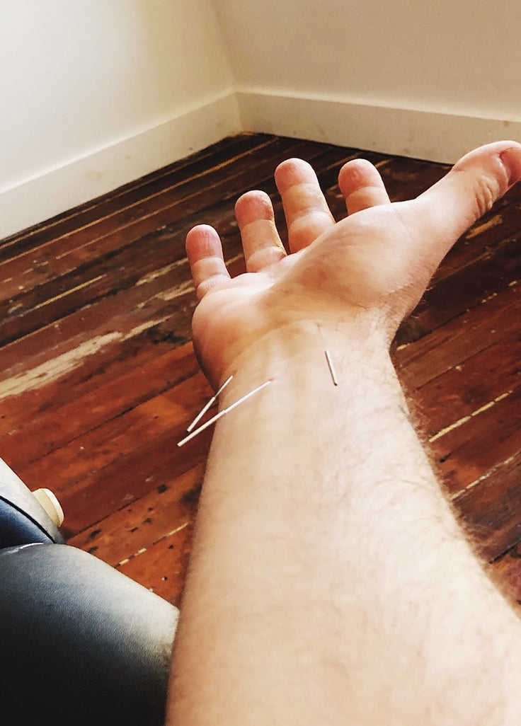 Acupuncture Needles in Wrist