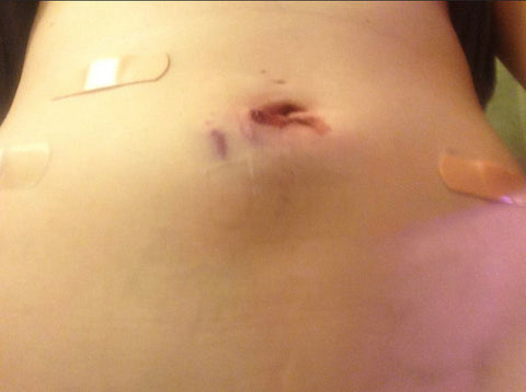 Endometriosis Surgery scars