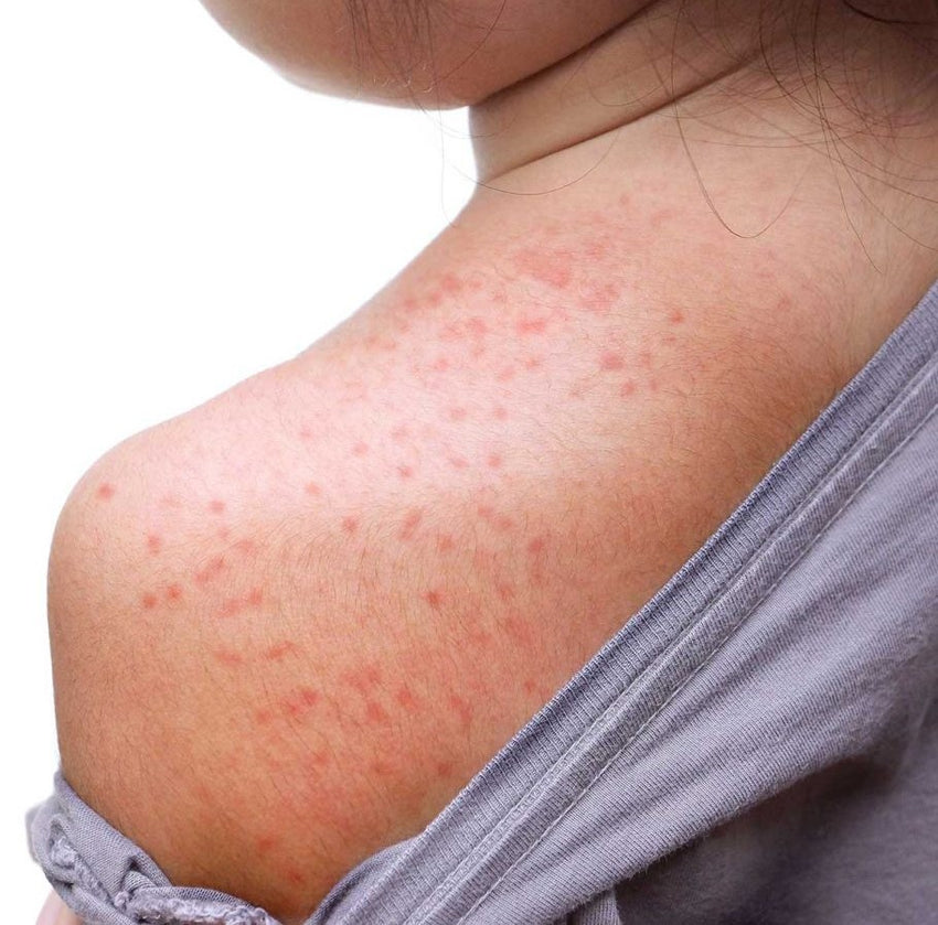 are-your-kids-suffering-with-itchy-red-bumps-snake-brand