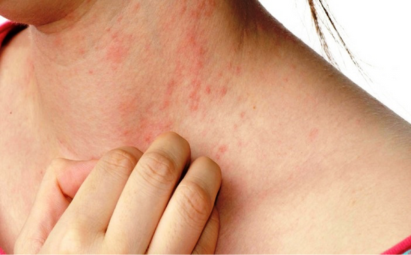 Heat rash: causes, treatment, prevention