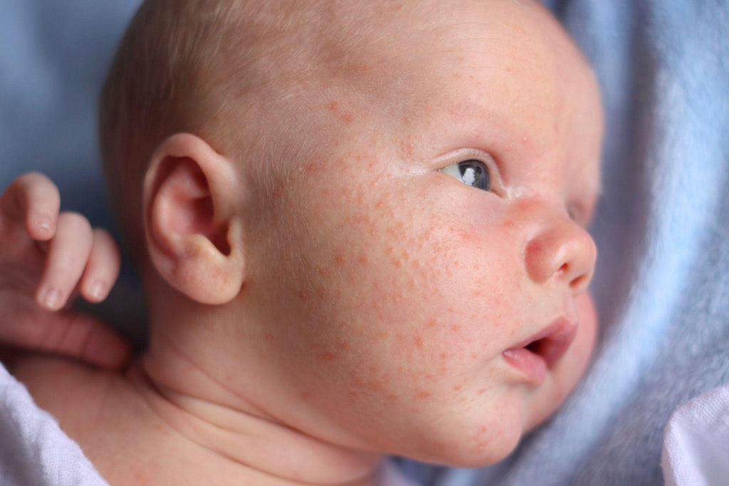 the wee bean image of baby acne 