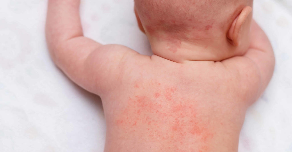 the wee bean image of baby heat rash