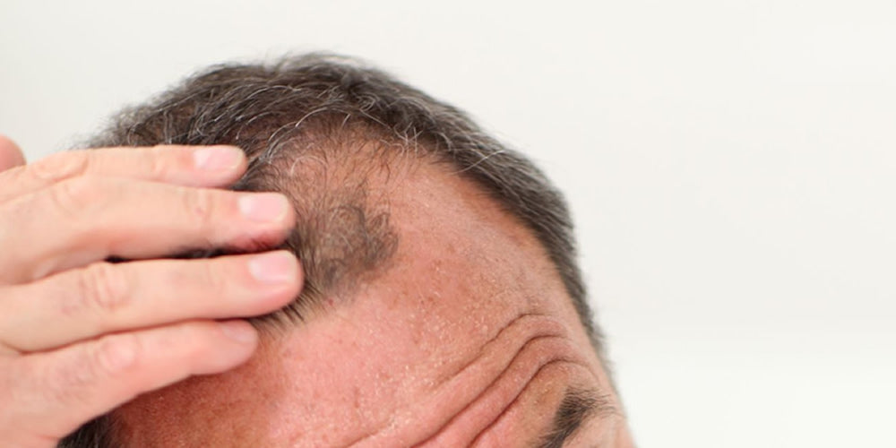 What is Male Pattern Baldness? | Reseed Hair Loss Range for Men and Women