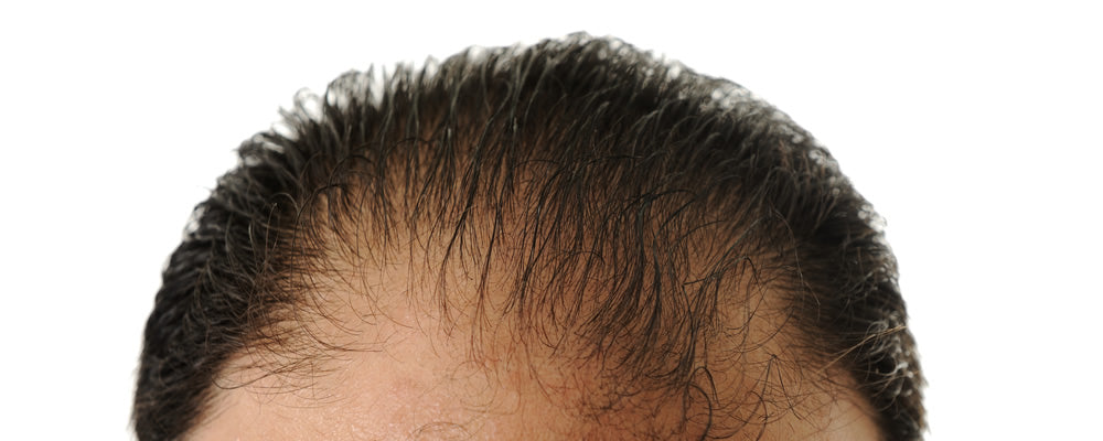 Female Pattern Baldness  Symptoms Causes Treatment  Prevention  Hair  Sure