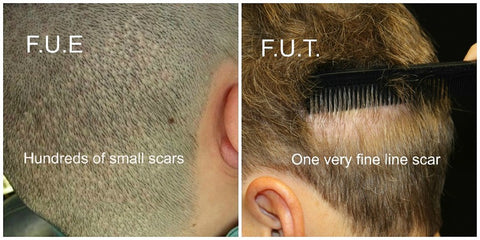 FUE vs FUT Scars at Donor Site