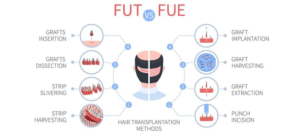 Follicular Unit Excision vs. Follicular Unit Transplantation