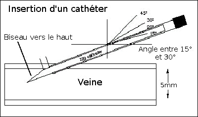 Soins infirmiers - Nouveau garrot fixe la veine à ponctioner