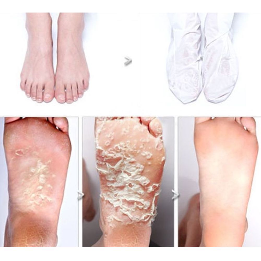 foot treatment for dead skin