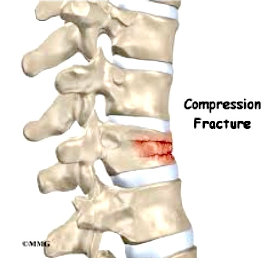 osteoporosis fracture recovery