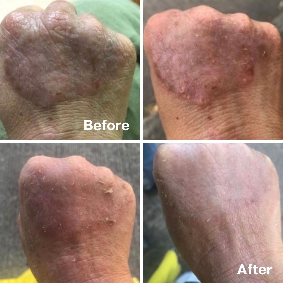 Eczema before and after