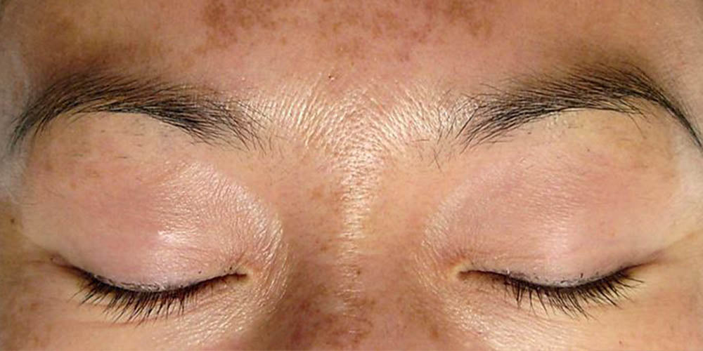 melasma on woman's face