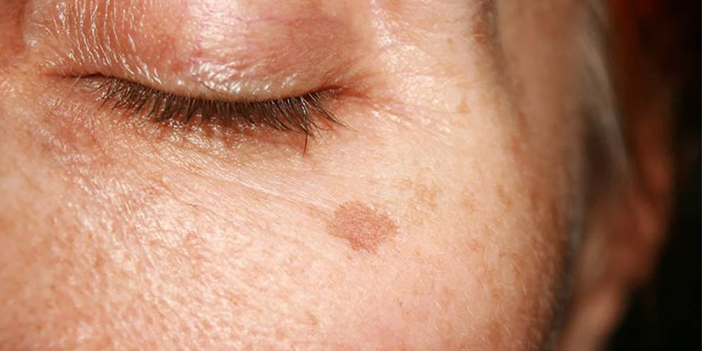 sun freckles on woman's face