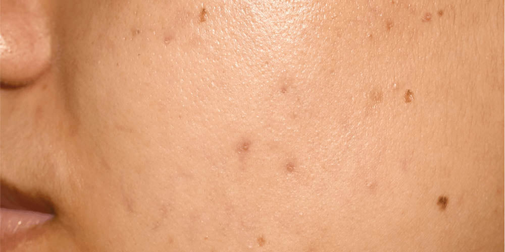 acne spots and hyperpigmentation