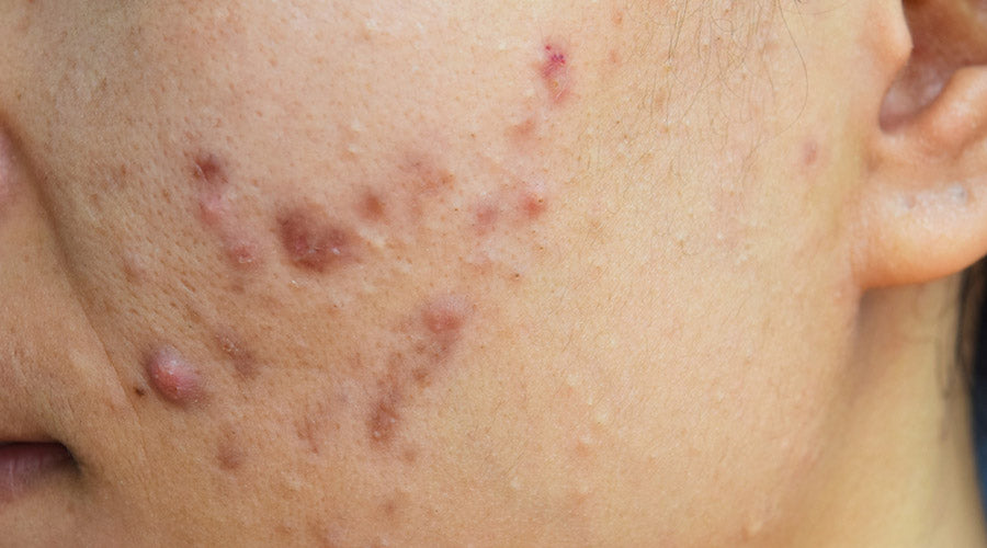 nodular acne