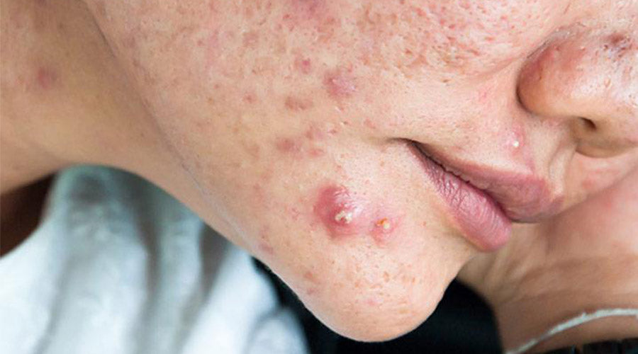 cystic acne