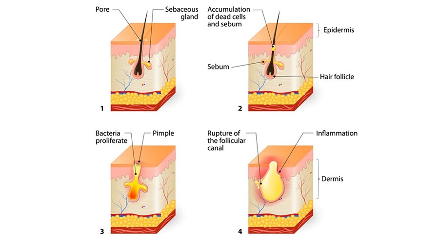 acne formation diagram