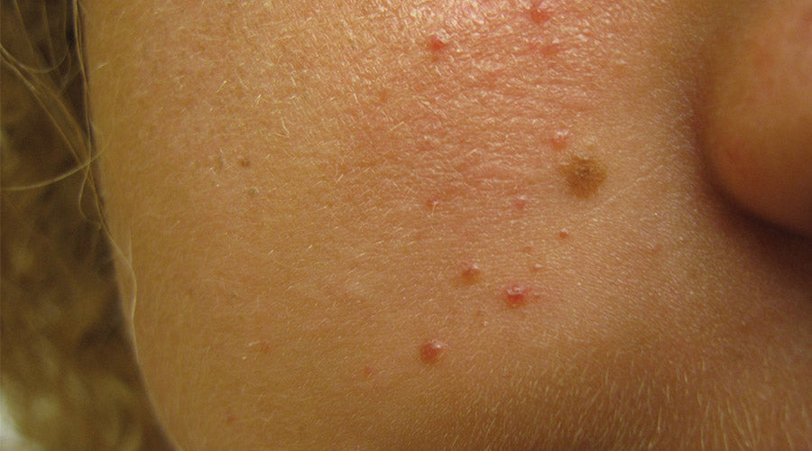 papules and pustules