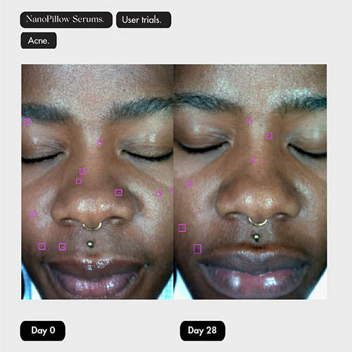 SKOON. NanoPillow Before and After