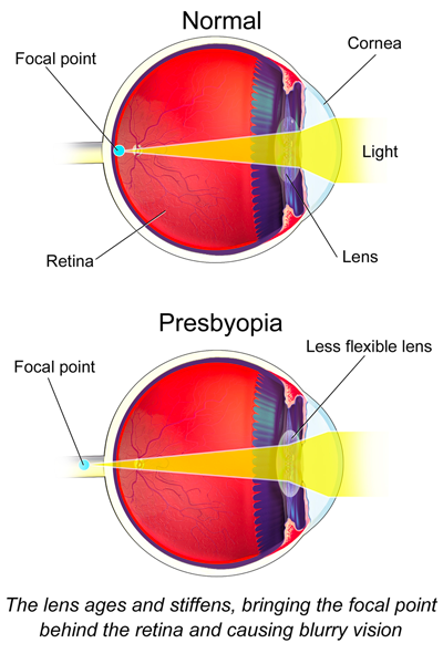 Eye illustration of normal vision vs low diopter strength due to presbyopia