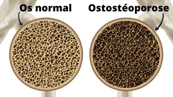 L'ostéoporose en image