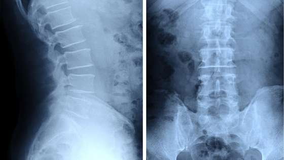 Un IRM, des radiographies sont des examens incontournables pour diagnostiquer la sténose lombaire