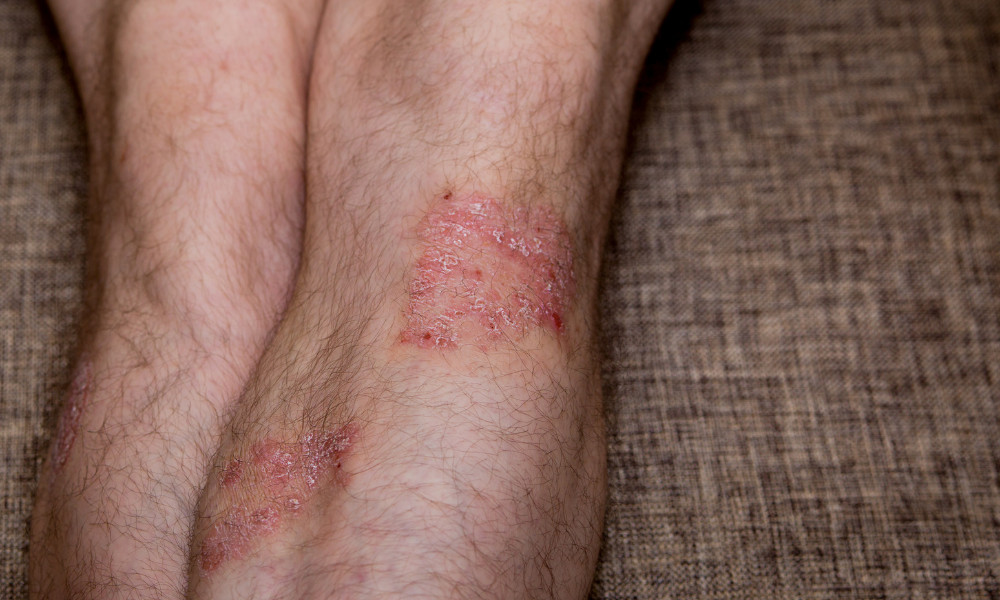 Psoriasis On The Legs What You Need To Know Nuvothera™ 