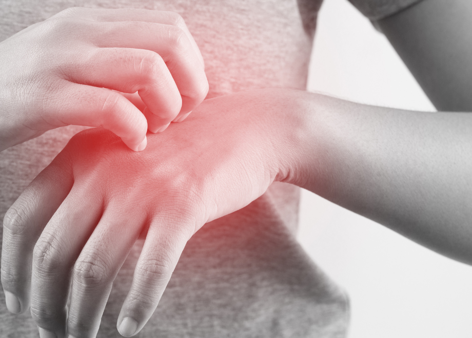 a mostly grey and white photo of a woman scratching her hand. The hand is partially red to indicate inflammation