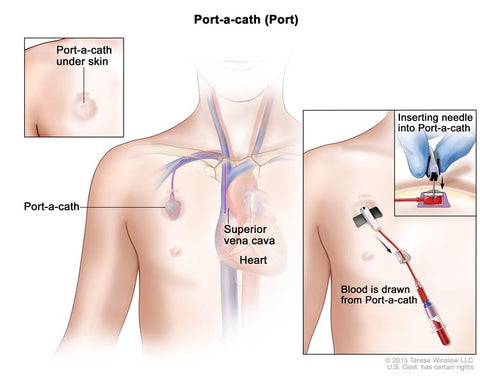 Port a Cath for Chemo