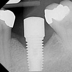 Hexed Dental Implant | Dental Implant Systems