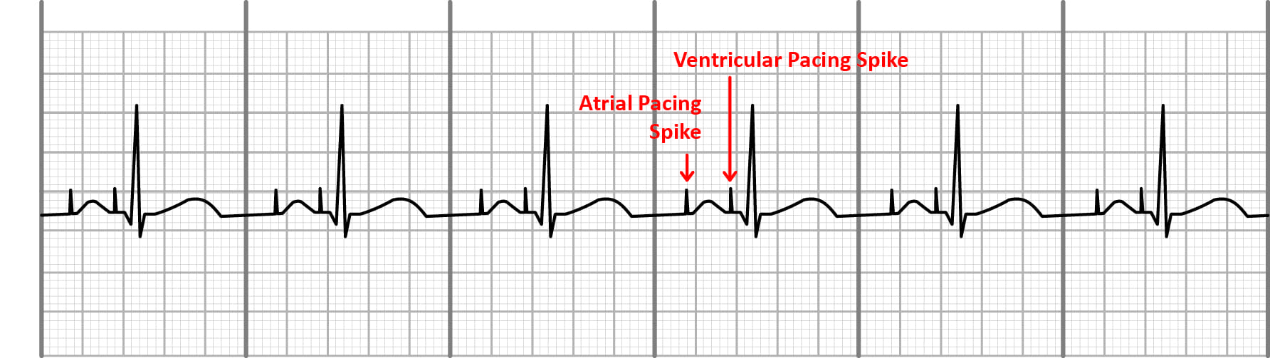 Atrial and ventricular pacing on an EKG