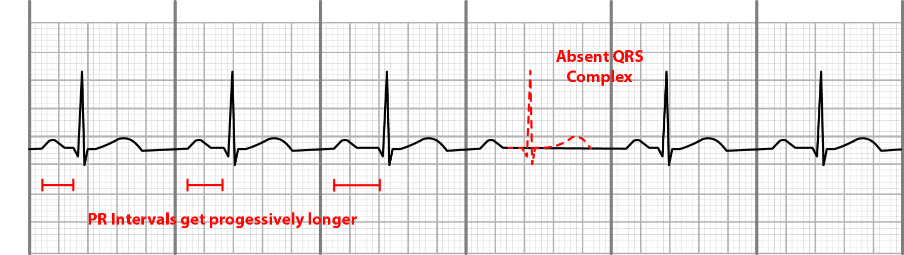 2nd degree AV block type 1 (Mobitz I, Wenckebach) on EKG