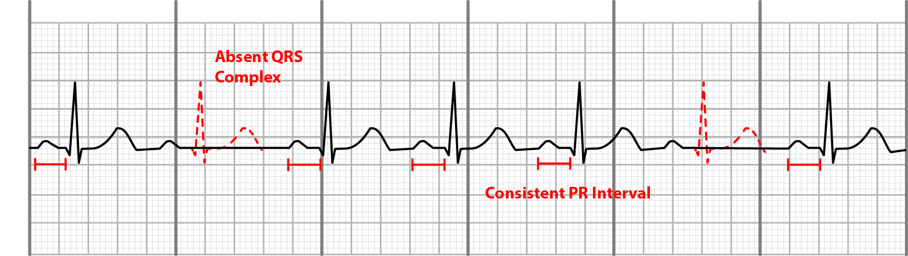 2nd degree AV block type 2 (Mobitz II) on EKG