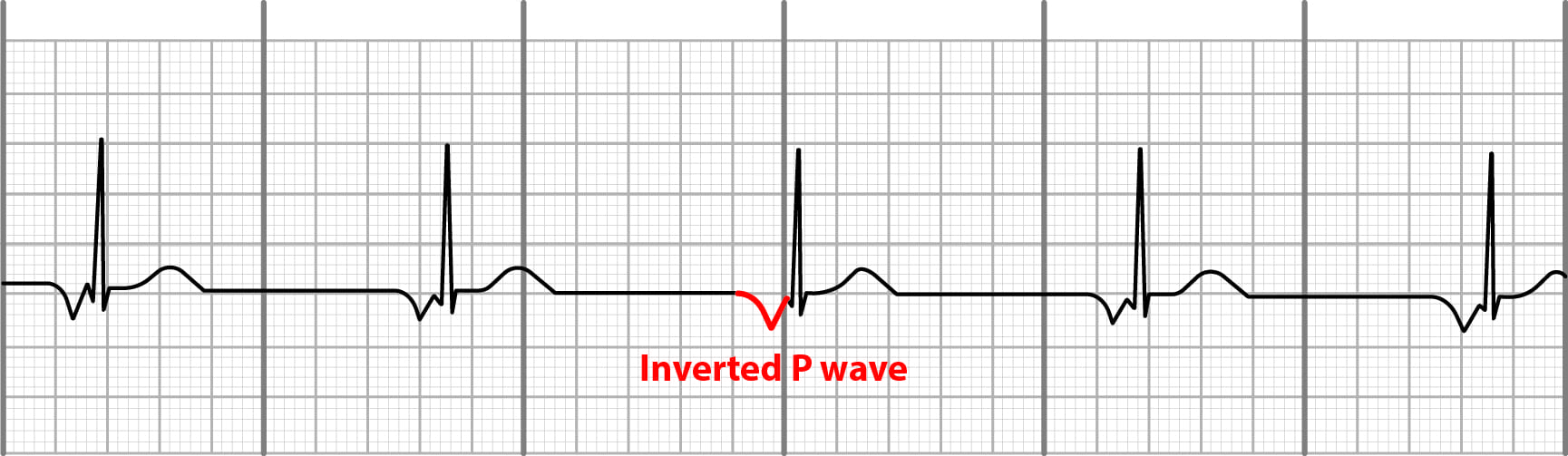 Junctional rhythm on EKG