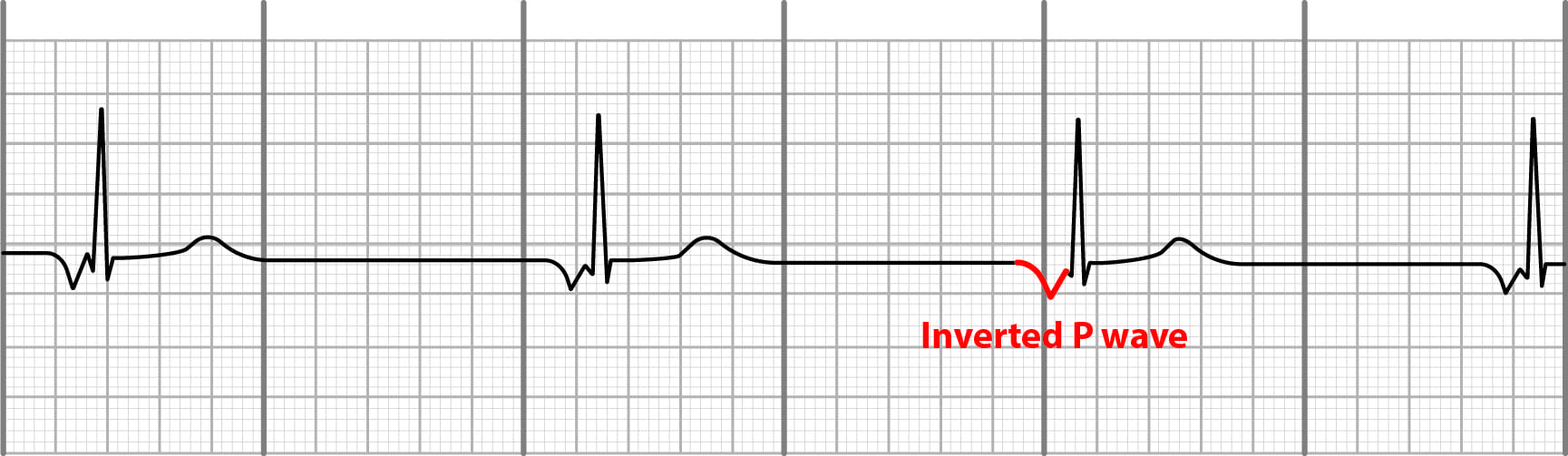 Junctional bradycardia on EKG
