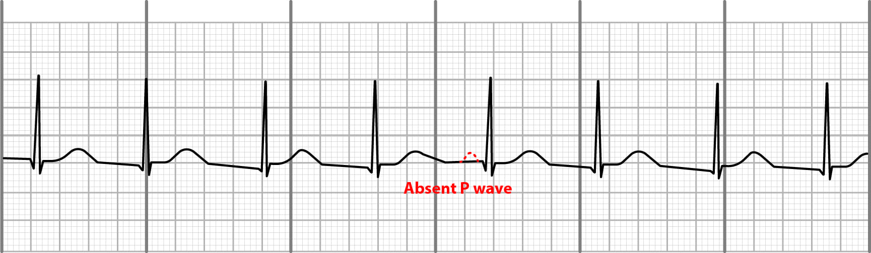 accelerated junctional rhythm on EKG