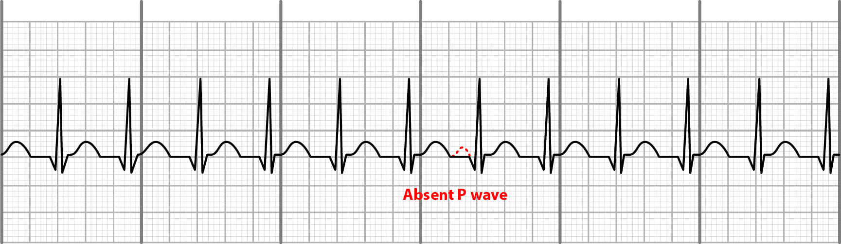 junctional tachycardia on EKG