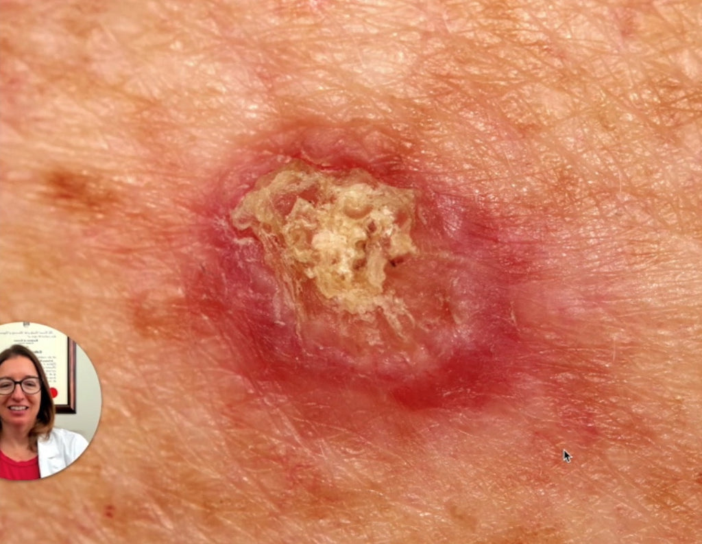 squamous cell carcinoma