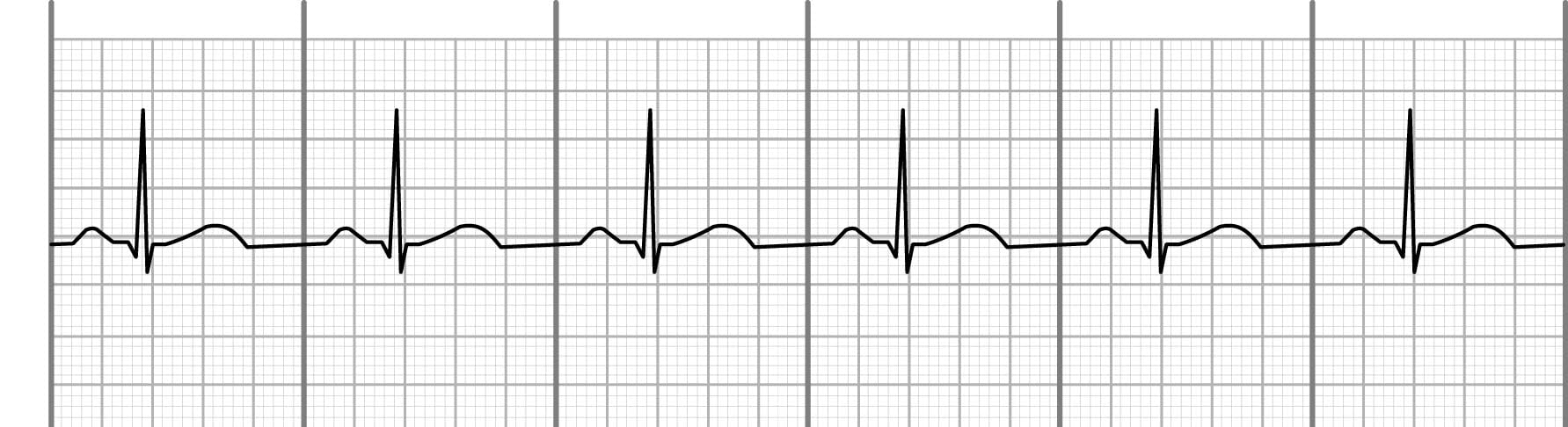 Normal sinus rhythm on an EKG